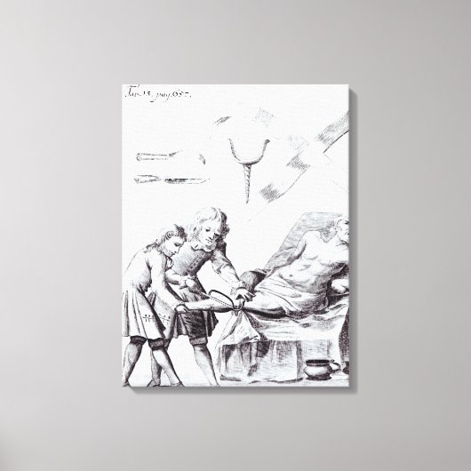 Chirurgische ingreep om een been te amputeren canvas afdruk (Voorkant)