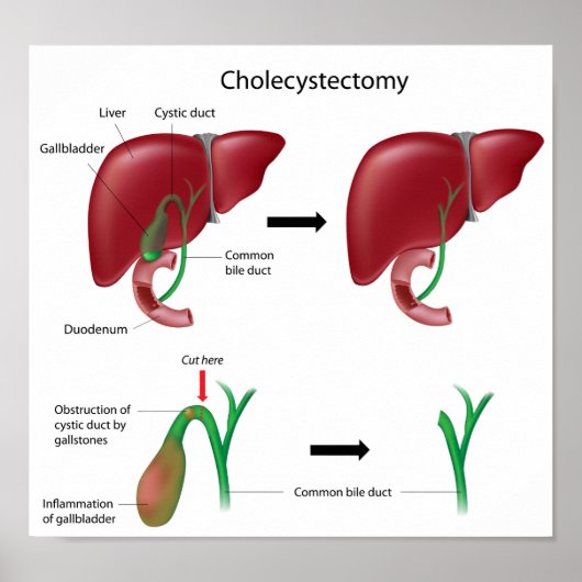 Cholecystectomie galblaasverwijderingsoperatie Pos Poster (Voorkant)