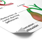 Cholecystectomie galblaasverwijderingsoperatie Pos Poster (Hoek)
