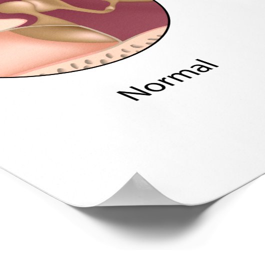 Cholesteatoma Poster in het middenoor (Hoek)