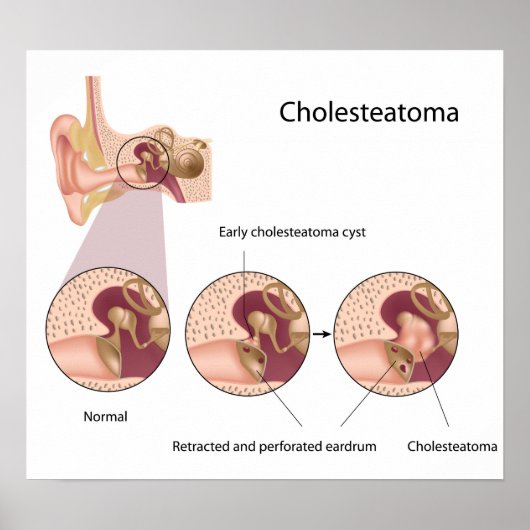 Cholesteatoma Poster in het middenoor (Voorkant)