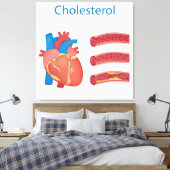 Cholesterol Canvas Afdruk (Insitu (Slaapkamer))