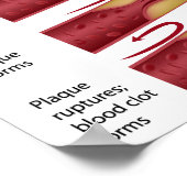 Cholesterolplaque fracties Poster (Hoek)