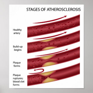 Cholesterolplaque fracties Poster