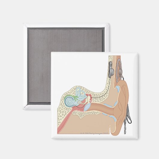 Cochlear Implantaten Magneet (Voorkant / Achterkant)