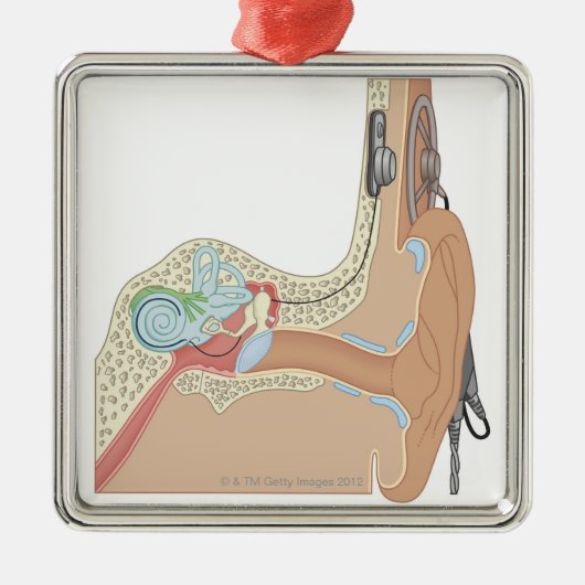 Cochlear Implantaten Metalen Ornament (Voorkant)