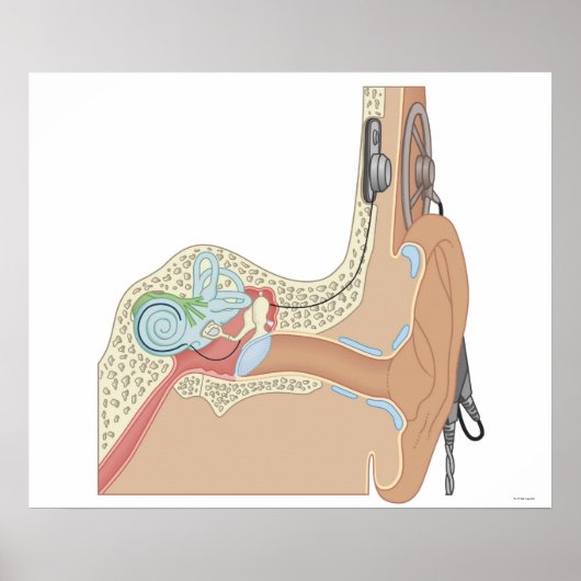 Cochlear Implantaten Poster (Voorkant)