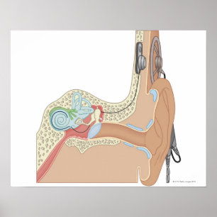 Cochlear Implantaten Poster