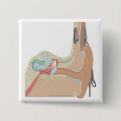 Cochlear Implantaten Vierkante Button 5,1 Cm (Voorkant)