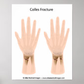 Colles fracture, medische illustratie. poster (Voorkant)