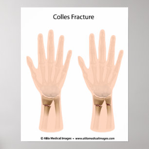 Colles fracture, medische illustratie. poster