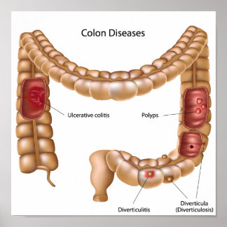 Colon pathologies-Poster Poster