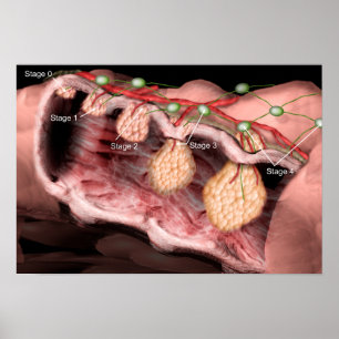 Colonkanker poster