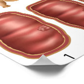 Colonkanker progressie Poster (Hoek)