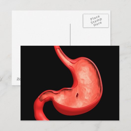 Conceptueel Afbeelding van eptische ulcera in buik Briefkaart (Voorkant / Achterkant)