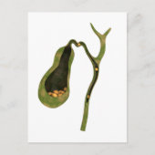 Conceptueel Afbeelding van galstenen in galgen Briefkaart (Voorkant)