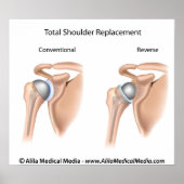 Conventionele versus omgekeerde totale schouderver poster (Voorkant)