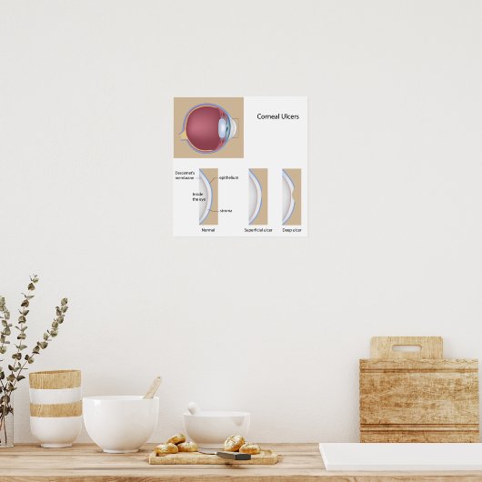 Corneusulcus oogaandoening Poster (Keuken)