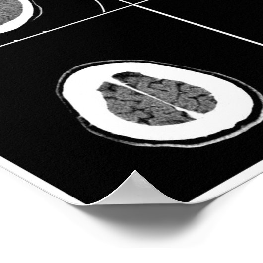 CT SCAN HEAD POSTER (Hoek)