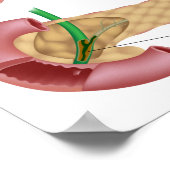 Cystische fibrose Poster (Hoek)