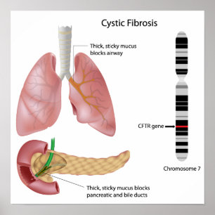 Cystische fibrose Poster