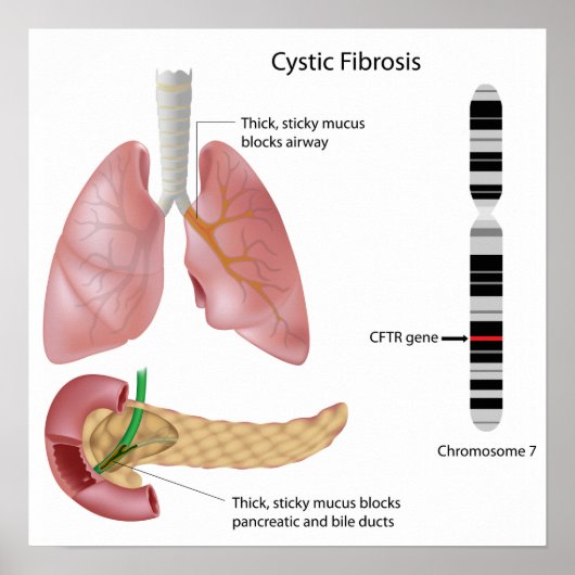 Cystische fibrose Poster (Voorkant)