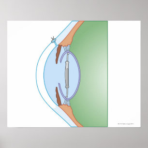 De Chirurgie van de cataract Poster