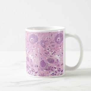 De mok-Borst van de koffie de Cellen van Kanker Koffiemok