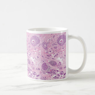 De mok-Borst van de koffie de Cellen van Kanker Koffiemok