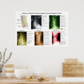 Degeneratie van de cervicale wervelkolom Chiroprac Poster (Keuken)