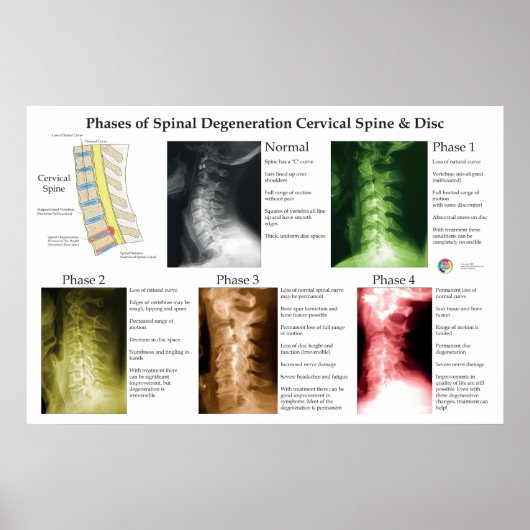 Degeneratie van de cervicale wervelkolom Chiroprac Poster (Voorkant)