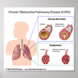 diagram COPD Lung-ziekten Poster