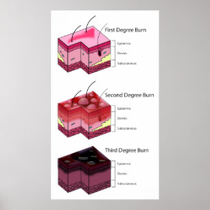 Diagram van huidbranden, eerste seconde en derde g poster