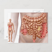 Diverticulitis in het dalende gebied van de klonen briefkaart (Voorkant / Achterkant)