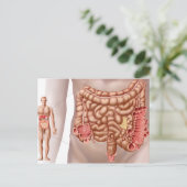 Diverticulitis in het dalende gebied van de klonen briefkaart (Staand voorkant)