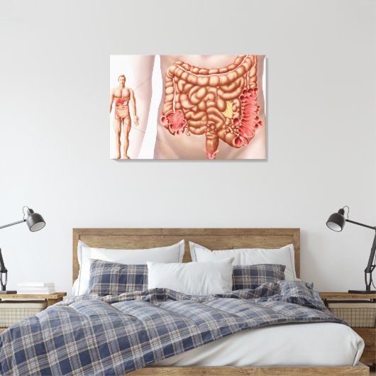 Diverticulitis in het dalende gebied van de klonen canvas afdruk (Insitu (Slaapkamer))