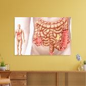 Diverticulitis in het dalende gebied van de klonen canvas afdruk (Insitu (Woonkamer))
