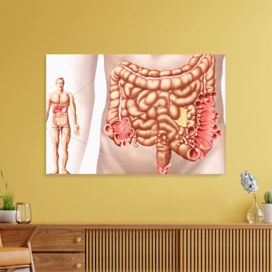 Diverticulitis in het dalende gebied van de klonen canvas afdruk (Insitu (Woonkamer))