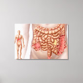 Diverticulitis in het dalende gebied van de klonen canvas afdruk (Voorkant)