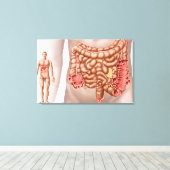 Diverticulitis in het dalende gebied van de klonen canvas afdruk (Insitu (Houten vloer))