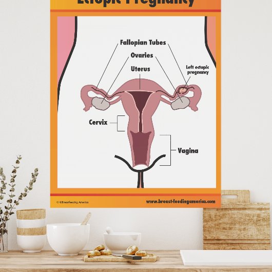Ectopic Zwangerschap Poster (Keuken)