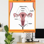 Ectopic Zwangerschap Poster (Thuiskantoor)