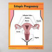 Ectopic Zwangerschap Poster (Voorkant)