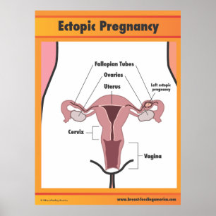Ectopic Zwangerschap Poster
