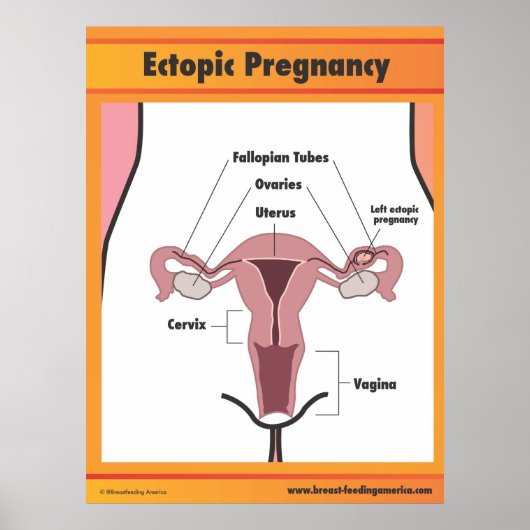 Ectopic Zwangerschap Poster (Voorkant)