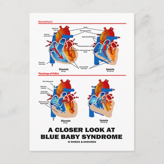 Een nadere blik op het Blue Baby-syndroom (hart) Briefkaart (Voorkant)