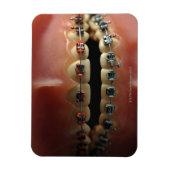 Een tandheelkundig model en de steunen van de Tand Magneet (Verticaal)