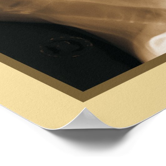 Effecten van cervicale spinale subluxatie Poster (Hoek)