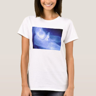 Elleboogstraal met schroeven t-shirt