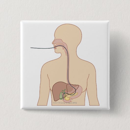 Endoscoop Vierkante Button 5,1 Cm (Voorkant)